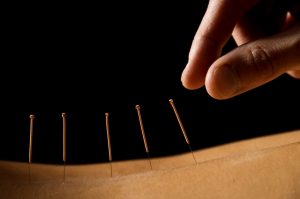 Best Acupuncture Therapy Treatments, Best Nature Cure Centres in INDIA | WorldWide